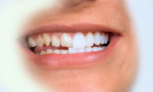На какие зубы ставят виниры?